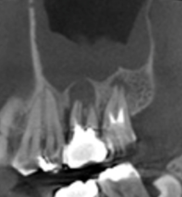 歯科用CT画像2